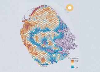 Прорив ШІ: виявлення прихованих типів ракових клітин, відкриття шляху до цільової терапії