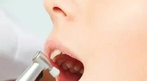 Sbiancamento dei denti fai da te: cosa funziona, cosa no e come stare al sicuro
